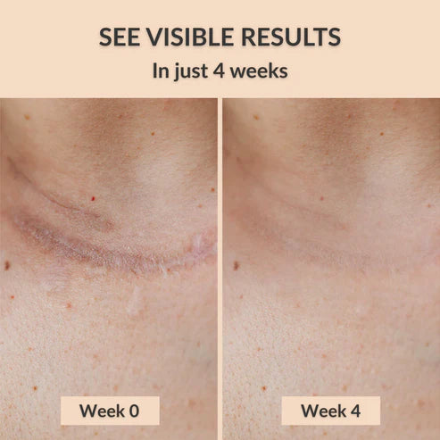 Silicone Scar Sheets