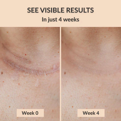 Silicone Scar Sheets